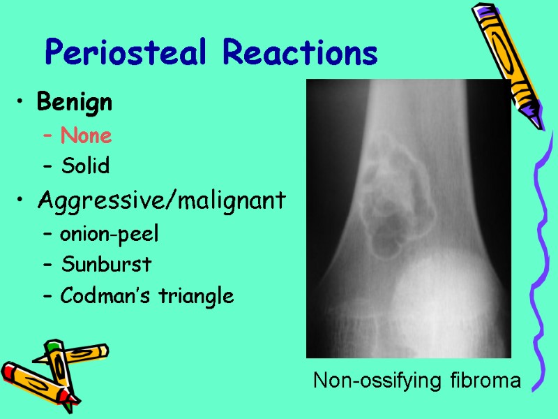 Periosteal Reactions Benign None Solid Aggressive/malignant onion-peel Sunburst Codman’s triangle Non-ossifying fibroma